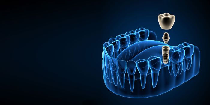The Art and Science of Dental Implant Placement in California